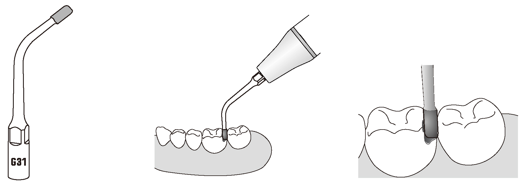 Сфера применения наконечника для скалера